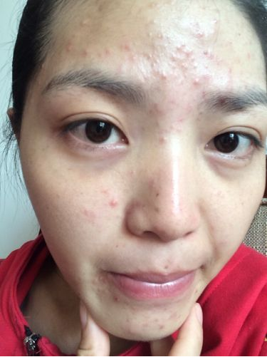 两块钱的红霉素软膏可以治痘痘？你太傻太天真