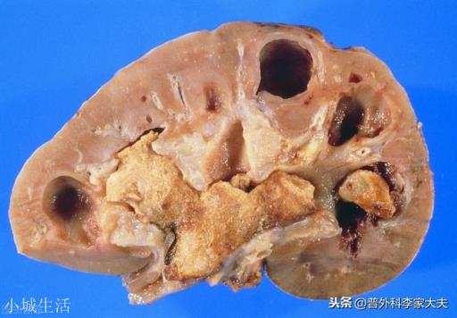 肾结石怎么办？