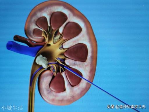 肾结石怎么办？
