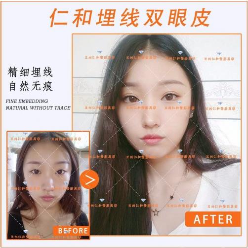 品质口碑让你安全变美 兰州仁和整形埋线双眼皮好不好