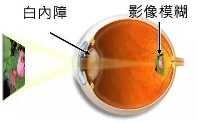 白内障、老花眼怎么治疗?手术治疗有效吗?