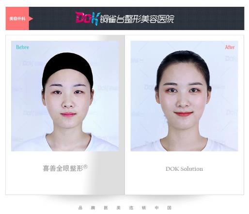 左万昌院长双眼皮技术 云南铜雀台整形医院全城案例招募