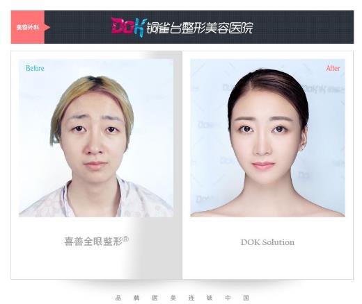左万昌院长双眼皮技术 云南铜雀台整形医院全城案例招募