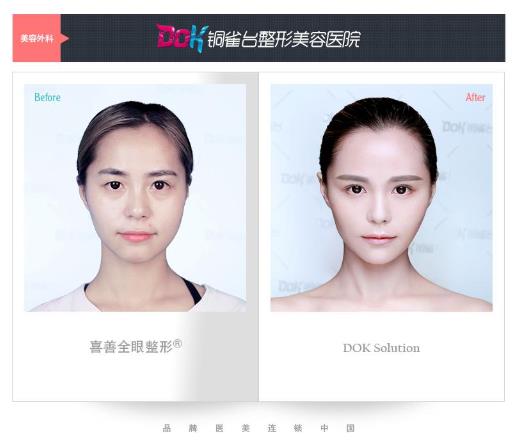左万昌院长双眼皮技术 云南铜雀台整形医院全城案例招募