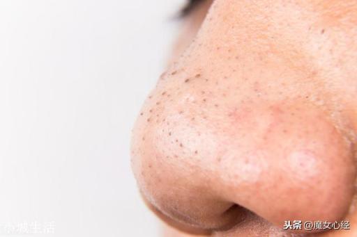卸妆不干净，全脸毛孔堵塞严重怎么办？