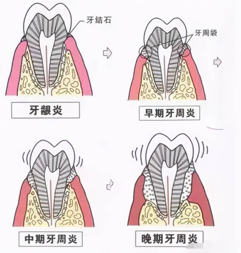 牙齿上发黑怎么回事 洁牙多少钱一次