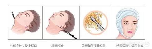 脸大该怎么瘦脸才好呢?