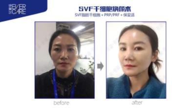 伊美尔幸福美容医院张德友讲解：什么是SVF干细胞焕颜术？
