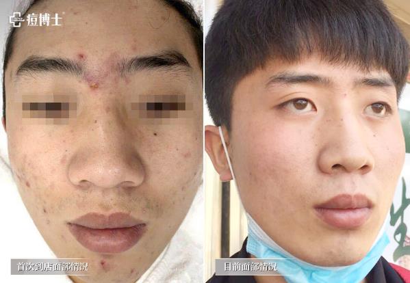 公益行动||跨越69座城，痘博士为痘友都做了么？