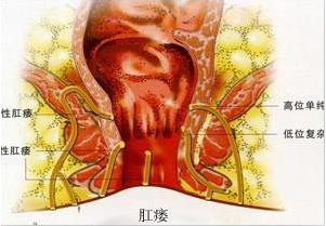 武汉汉西博仕肛肠医院有这5个异常很可能中了肛瘘的招