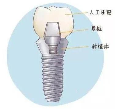 全民爱牙公益行动援助缺牙患者安心做种植牙