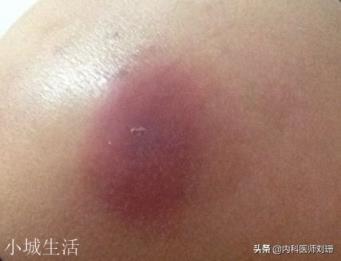 有时候古人“背后长了一个疮”就会死亡是真的吗？为什么？