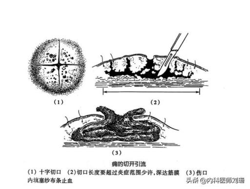 有时候古人“背后长了一个疮”就会死亡是真的吗？为什么？