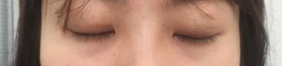 明眸翘睫大眼术——点亮你的双眼 宿州阳光整形医院咋样