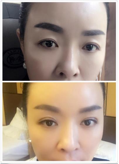 明眸翘睫大眼术——点亮你的双眼 宿州阳光整形医院咋样