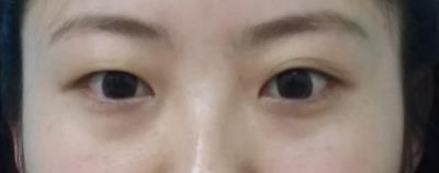 明眸翘睫大眼术——点亮你的双眼 宿州阳光整形医院咋样