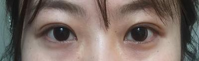 明眸翘睫大眼术——点亮你的双眼 宿州阳光整形医院咋样