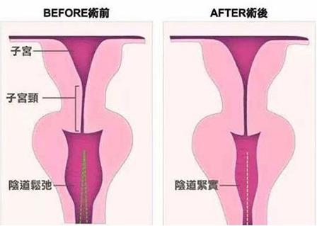 重庆军科私密整形医院,发生阴道松弛怎么办?