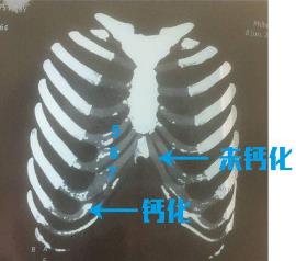 北京伊美尔健翔医院:肋软骨隆鼻多少钱