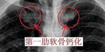 北京伊美尔健翔医院:肋软骨隆鼻多少钱