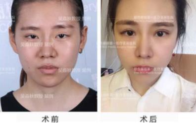 解读关于全切双眼皮你不知道的事