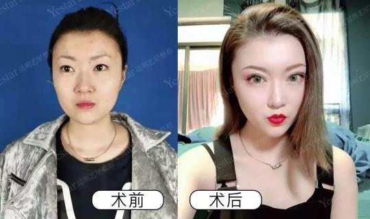 美丽独秀高贵皇后 昆明艺星整形做双眼皮好吗