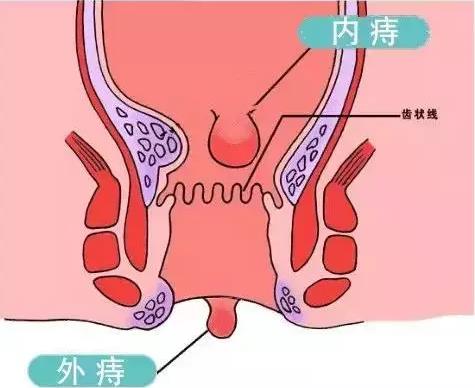 西安东大肛肠医院:痔疮还分软硬,硬的和软的有啥区别?