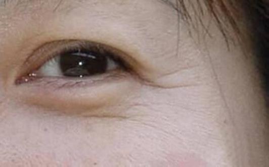 为你消除眼袋肌肤问题 如何去眼袋有效