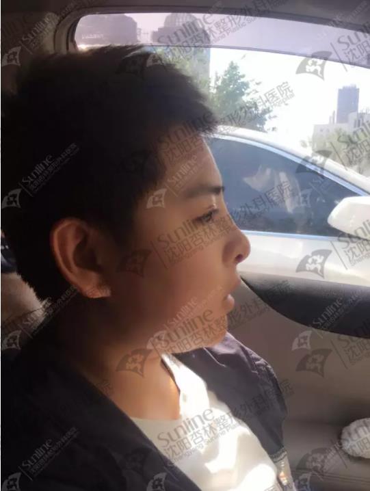 鼻綜合和隆鼻有什么區別？沈陽做鼻綜合價格多少？