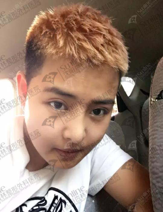 鼻綜合和隆鼻有什么區別？沈陽做鼻綜合價格多少？