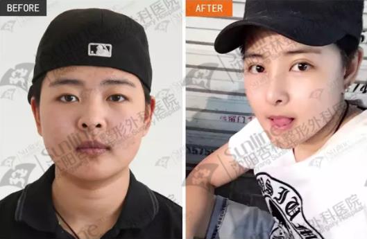 鼻綜合和隆鼻有什么區別？沈陽做鼻綜合價格多少？