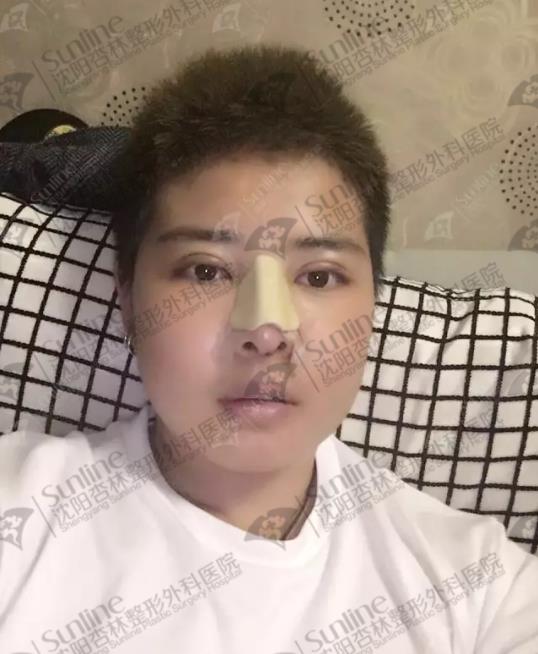 鼻綜合和隆鼻有什么區別？沈陽做鼻綜合價格多少？