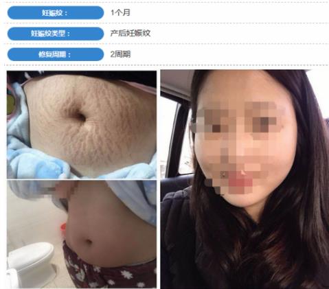 妊娠纹用什么产品好，权威祛妊娠纹产品排行榜