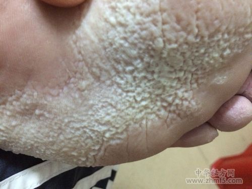 脚底出汗的治疗偏方 防止脚出汗的小妙招