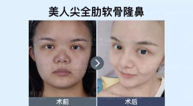 党院教你怎么选 重庆联合丽格整形肋软骨隆鼻