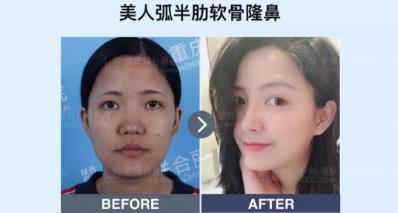 党院教你怎么选 重庆联合丽格整形肋软骨隆鼻