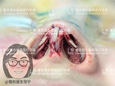 党院教你怎么选 重庆联合丽格整形肋软骨隆鼻