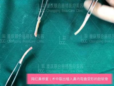 党院教你怎么选 重庆联合丽格整形肋软骨隆鼻