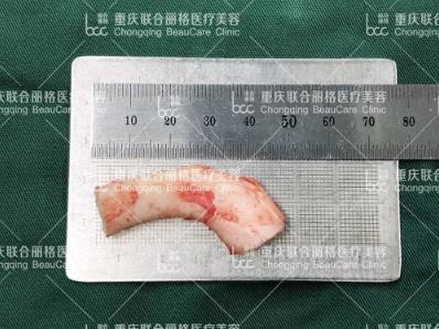 党院教你怎么选 重庆联合丽格整形肋软骨隆鼻