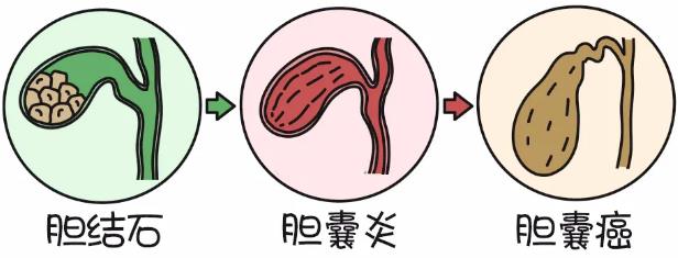 胆结石不用开刀!济南显微外科医院巧用2面"镜子"全部取出