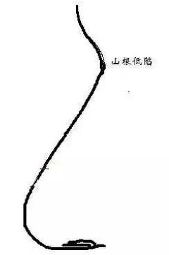 /玻尿酸 『山根低』假体