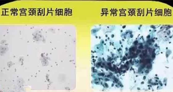 宫颈刮片的检查项目 宫颈刮片结果怎么看