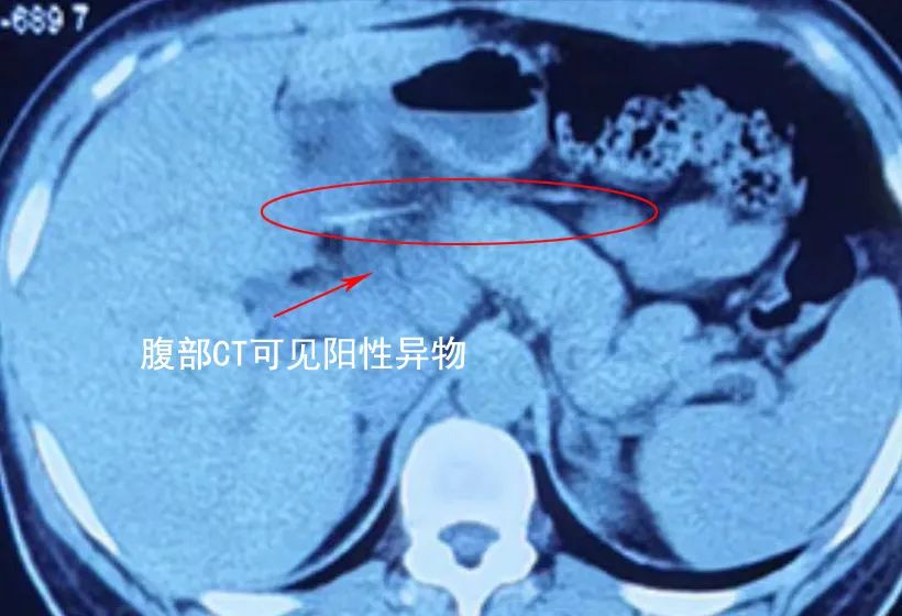 合川宏仁医院普外科急诊患者腹痛难忍，竟是3.5CM鱼刺划破肠