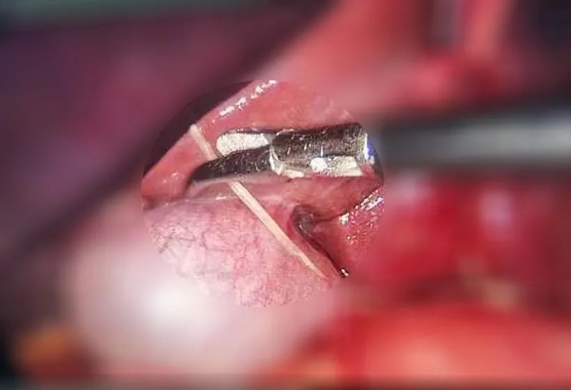 合川宏仁医院普外科急诊患者腹痛难忍，竟是3.5CM鱼刺划破肠