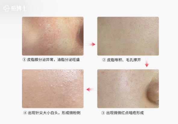博士说痘||博士总结出痘痘8种造坑大法!试看痘痘在老巢怎么作?——细说细胞祛痘之六