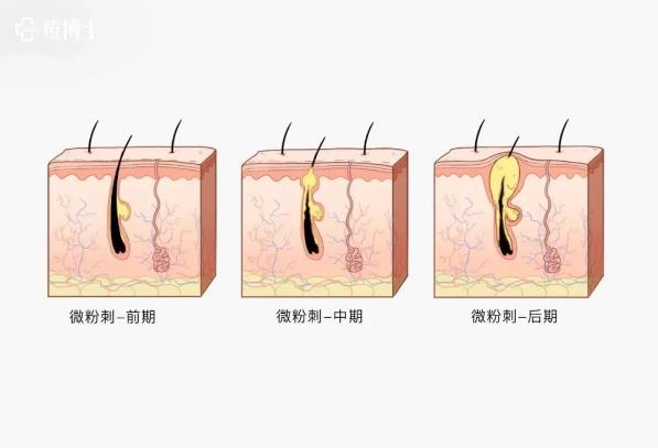 博士说痘||博士总结出痘痘8种造坑大法!试看痘痘在老巢怎么作?——细说细胞祛痘之六