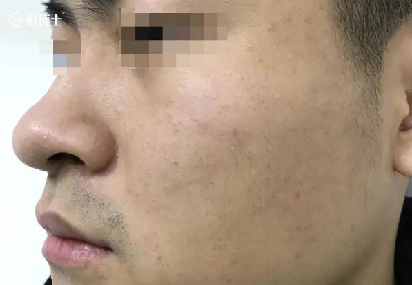 博士说痘||博士总结出痘痘8种造坑大法!试看痘痘在老巢怎么作?——细说细胞祛痘之六