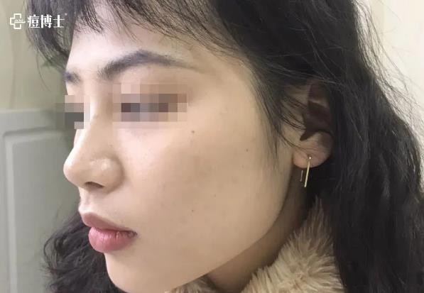 博士说痘||博士总结出痘痘8种造坑大法!试看痘痘在老巢怎么作?——细说细胞祛痘之六