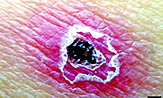 《肘后备急方》记载距今已大约1600年 世界最早记载的恙虫病症