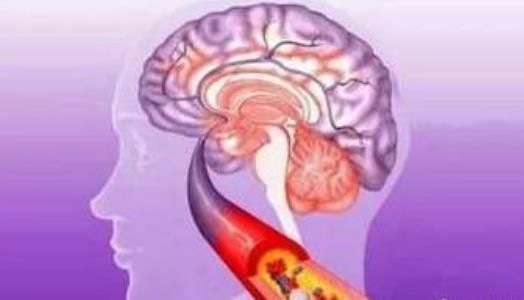 為什么會出血性腦梗死？出血性腦梗死有哪些并發癥？
